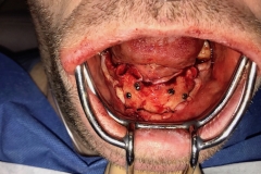 Surgical Site Exposed  with AICBG screws in place